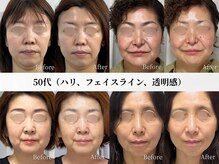 アストリエ グレース 相模大野(Astorie Grace)/リフトアップ｜Before→After