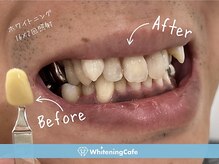 ホワイトニングカフェ 立川店(WhiteningCafe)/◎歯のホワイトニング施術写真◎