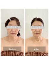 ステラルーテ(Stella lute)/【脳洗浄1回】小顔効果抜群!!