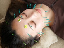 プライムライフ(prime-life)の雰囲気（目元・輪郭が上がり、お顔の印象が変わる美容鍼灸が人気です。）