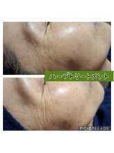 ハナ(HANA)/ハーブトリートメント