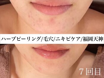 ホワイトアクア 福岡天神店(WHITE AQUA)/ハーブピーリングビフォー