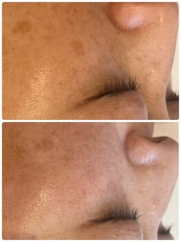 ミピブ 梅田(mipibu)/シミケア プラズマ&光フォト