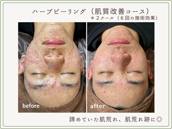 べセラ(BESERA)/ハーブピーリング(肌質改善)