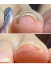 リネイル 長浜(Re-na-iL)/ネイルケア＆スパ¥7000