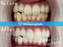 ホワイトニングカフェ 松本店(WhiteningCafe)/ホワイトニングビフォーアフター