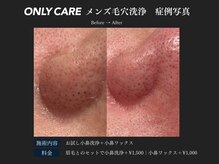 オンリィケア 関大前(ONLY CARE)/【メンズ毛穴洗浄】