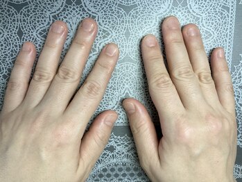 桃の木 吉祥寺店/爪のお悩み[深爪】初回