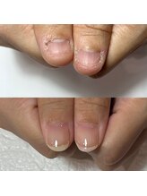 セラキュアネイル(Theracure nail)/自爪育成で別人級の爪の変化