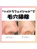 【毛穴ごっそり吸引お掃除】見て触ってツルツル肌実感￥7.700（90分）