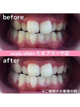 エクシアホワイトニング たまプラーザ店/ビフォーアフター