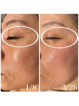 楚々(SOSO)/before after2回導入