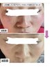 【最強美白】剥離なしピーリング&エクソソーム！自分史上美肌¥10000→¥6000
