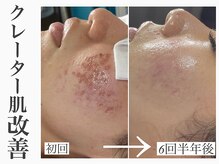 レイ(Rey)の雰囲気（韓国角質整理。ポロッと不要な角質をケアし凹凸をフラットに改善）