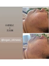 あいはな/小顔矯正×美容鍼　