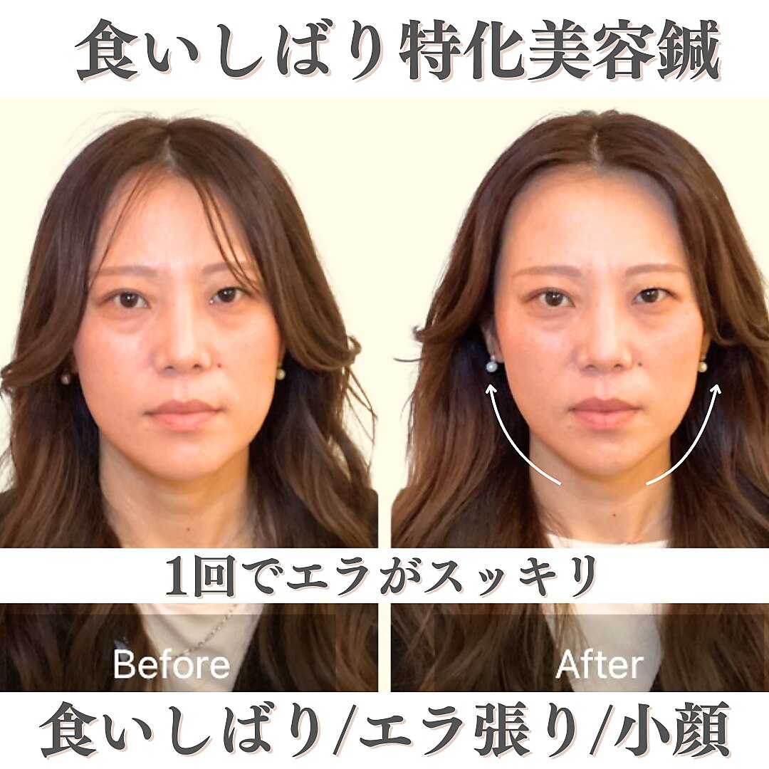 HARIRI 美容鍼 セルフ美容鍼”HARIRI” - ほうれい線の本格ケアにHARIRI 5箱 【公式通販】