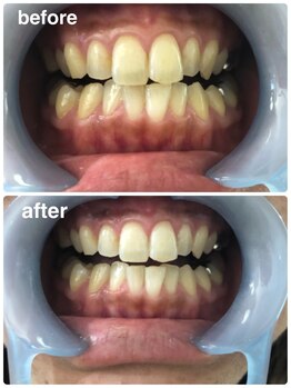 ラブ美長寿 沖縄本店(Lab)/ホワイトニングビフォーアフター