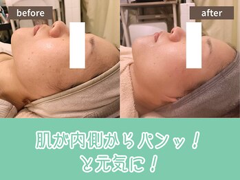 キザシ(kizashi)/【超リフト】二重顎改善☆