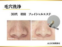 アルゴ 堺東駅前店(ALGO)/毛穴洗浄＋光脱毛