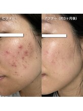 マロン(MARON)/月1ハーブで赤ニキビ落ち着く