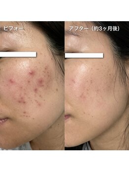 マロン(MARON)/月1ハーブで赤ニキビ落ち着く