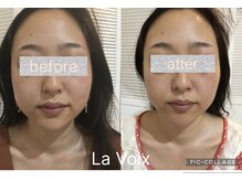 ラ ヴォワ 東銀座(La Voix)/小顔矯正　小顔コルギ　5回