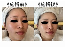 コタ(COTA)の雰囲気（会話はなし。ハイドロ毛穴洗浄とプラチナ美容液で眠るエステ。）