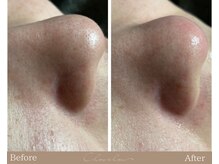 シュシュ(Chou chou)/【Before★After】毛穴