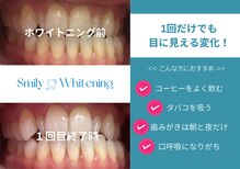 スマイリーホワイトニング(smilywhitening)