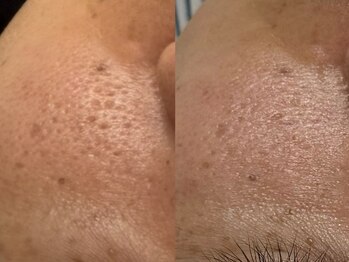 フェリス(FELIZ)/毛穴の引き締めにはプラズマ