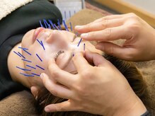 ボニー(Bonnie)/【美容鍼灸】