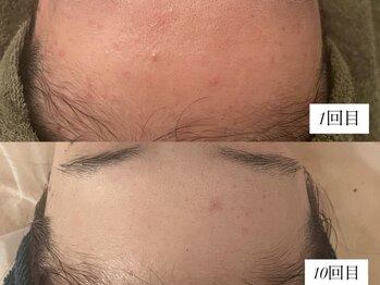 サロンワイアネシス(Salon y ANESIS)/ハーブピーリング 10回の変化