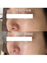 リラ 郡山店(Lilas)/ララピールで美白＋毛穴レスに