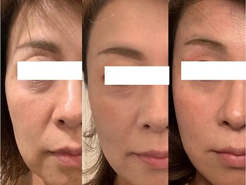 ピュアノア 三木店/肌質改善フェイシャル　三木小野