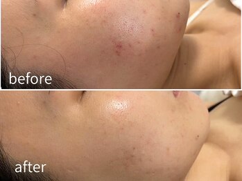 ソレイユ(Soleil)/毛穴・角質ケア