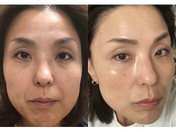 メルシー サロン(Merci Salon)/46歳/素肌になれる肌質チェンジ