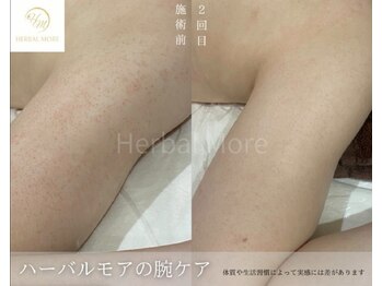 スキニティ 池袋(sknity)/<二の腕>ざらつきを抑え潤い美肌