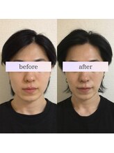 小顔革命 心斎橋/小顔矯正＋超音波リフトアップ