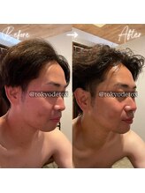 東京デトックス/小顔造形頭ほぐしFビフォアフ