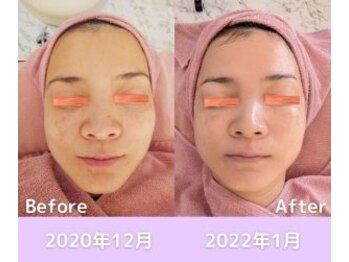 スフィア(Sphere)/ビフォアフ:プラズマシャワー1年