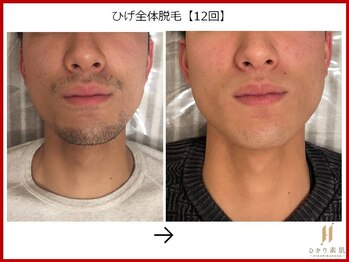 ひかり素肌/ひげ脱毛12回