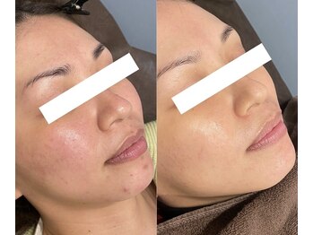 ボンズ(bonds.)/ニキビケアフォト&リゼネレート