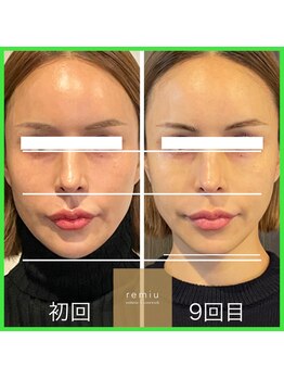 レミュー(remiu)/小顔パーソナル★テラボーラー