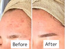 アンリミット 恵比寿店(Unelimit)/ハーブピーリング/ピーリング