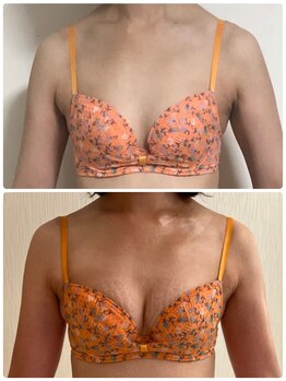 カナエルサロン 旭川(KANAERU SALON)/【バストアップ】症例☆