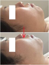 エクラ(e'clat)/顎裏のもたつき二重顎スッキリ◎