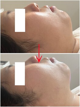 エクラ(e'clat)/顎裏のもたつき二重顎スッキリ◎