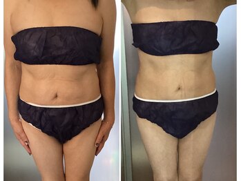 アリス 赤坂/60代からのボディーメイク！