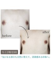 ティンクル サロン(Twinkle salon)/乳輪周りの脱毛