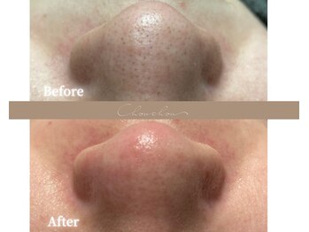 シュシュ(Chou chou)/【Before★After】毛穴